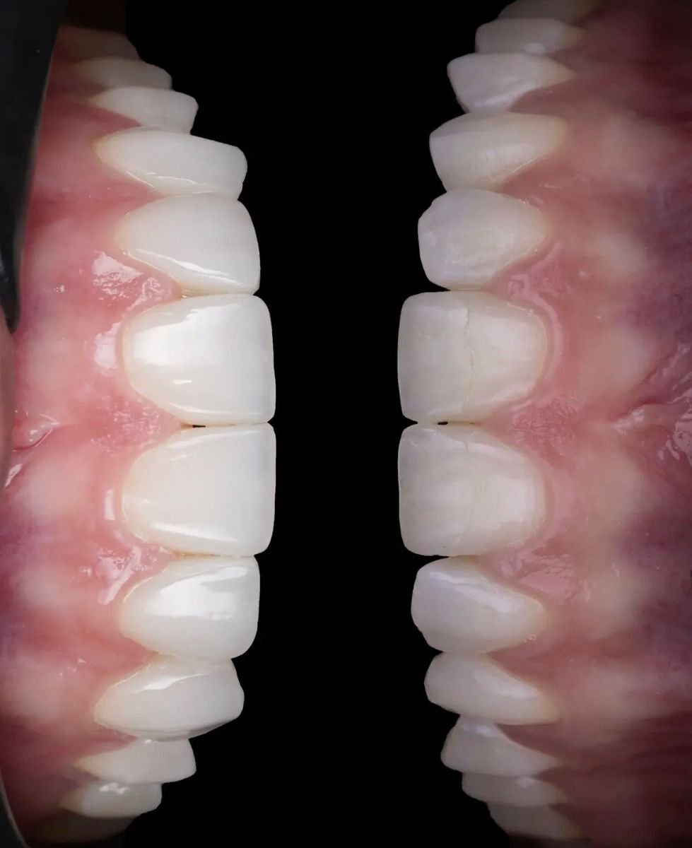 Before and after no prep veneers result at DENTAL CLINIC SHTERN, smile transformation
