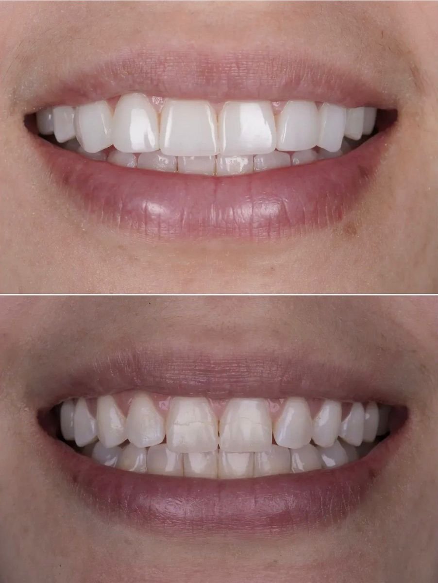 Before and after no prep veneers results at DENTAL CLINIC SHTERN, smile makeover