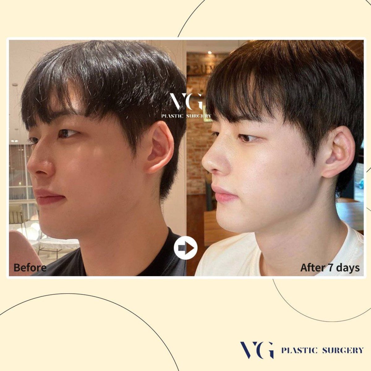 Resultados de rinoplastia antes y después en VG Plastic Surgery, nariz a los 7 días