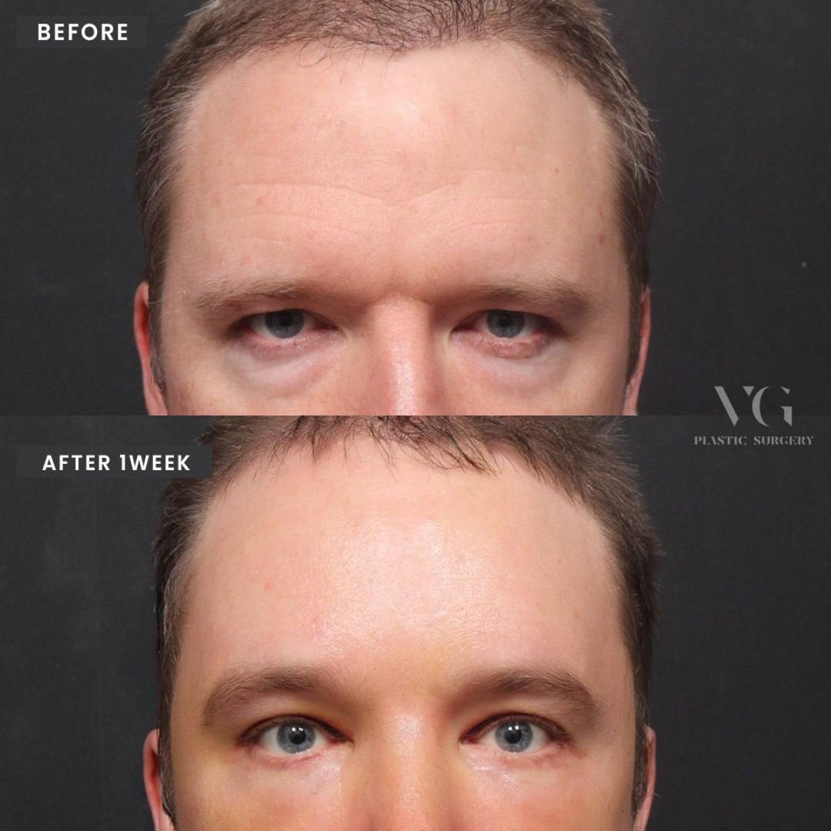Resultados de blefaroplastia de párpado inferior antes y después en VG Plastic Surgery, 1 semana