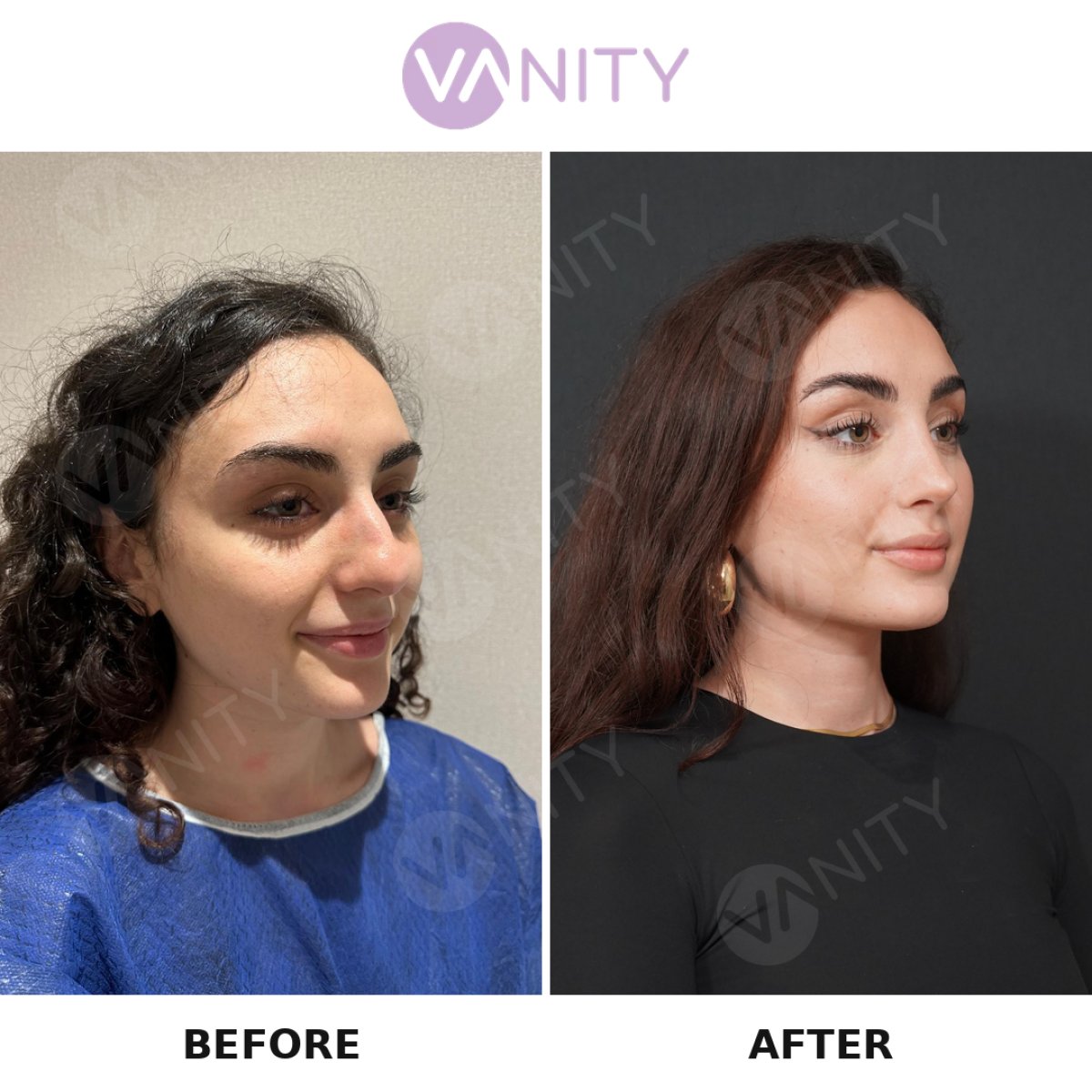 نتائج عملية تجميل الأنف قبل وبعد في Vanity Cosmetic Surgery Hospital، تحسين شكل الأنف