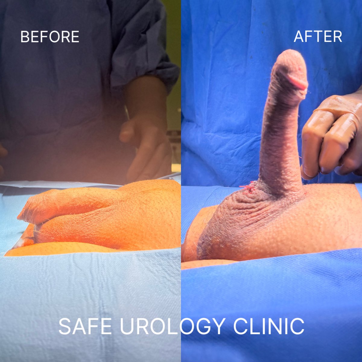 Resultados antes y después de implante de pene en Safe Urology Clinic, mejora funcional