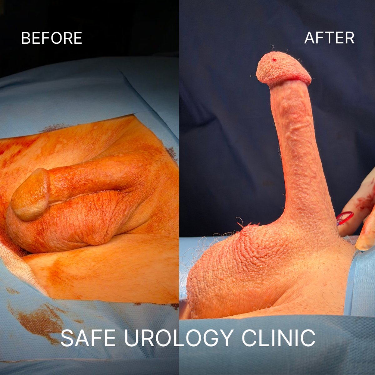 نتائج قبل وبعد زراعة دعامة القضيب في Safe Urology Clinic، تحسين الوظيفة