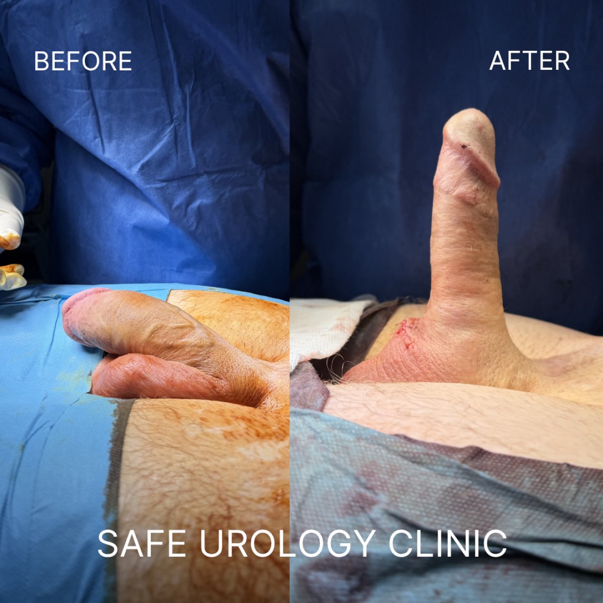 نتائج قبل وبعد زراعة دعامة القضيب في Safe Urology Clinic مع تحسين الوظيفة