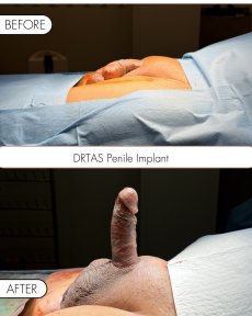 Penile implant Coloplast Titan with Lifetime Surgical Support - photo 4
