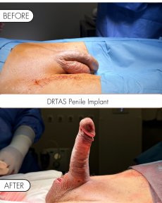 Penile implant Coloplast Titan with Lifetime Surgical Support - photo 5