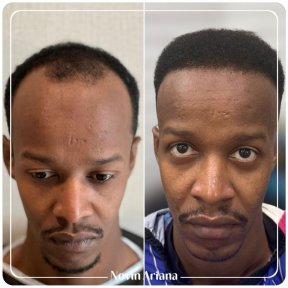 Plus Sapphire FUE hair transplant All Included - photo 4
