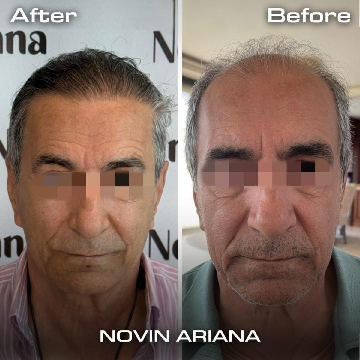 Before and after Sapphire FUE hair transplant result at NOVİN ARİANA SAĞLIK VE TURİZM clinic