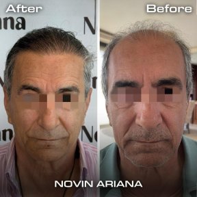 Plus Sapphire FUE hair transplant All Included - photo 6