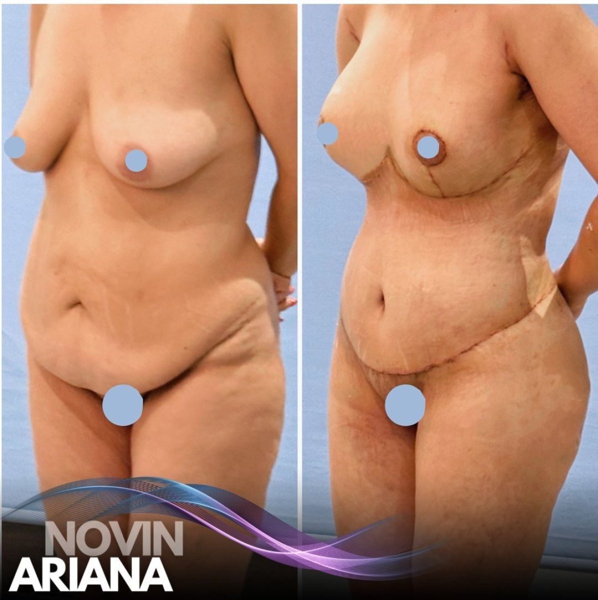 Résultats avant et après réduction mammaire et abdominoplastie chez NOVİN ARİANA SAĞLIK