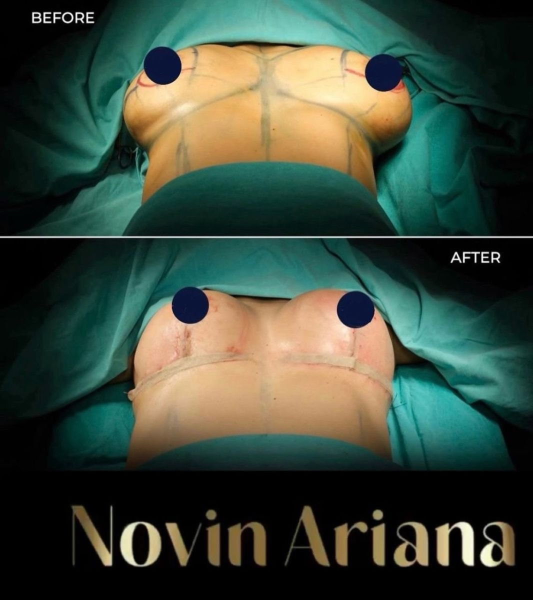 Résultats avant et après réduction mammaire chez NOVİN ARİANA SAĞLIK VE TURİZM LİMİTED ŞİRKETİ