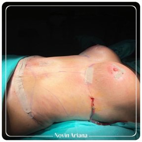 Standard Breast Lift and reduction All Included - photo 5