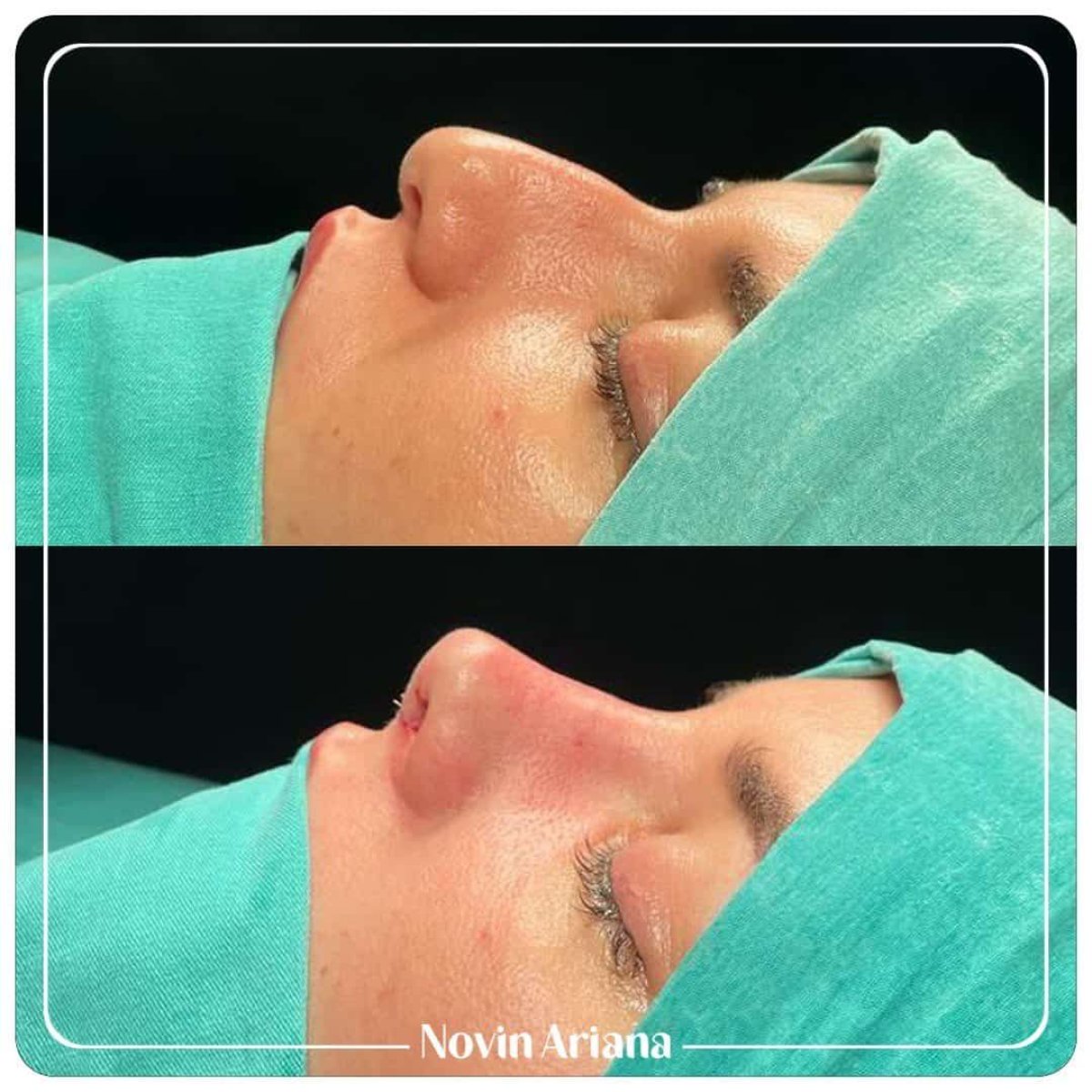 نتائج قبل وبعد عملية تجميل الأنف التصحيحية في NOVİN ARİANA SAĞLIK VE TURİZM LİMİTED ŞİRKETİ