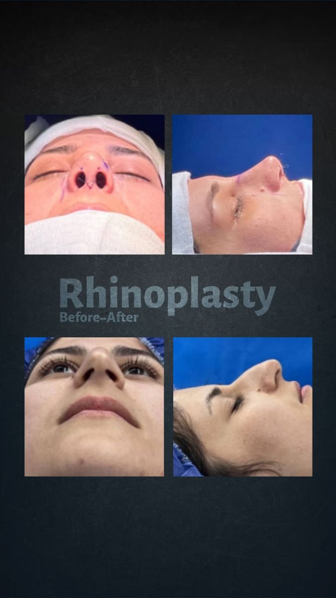 نتائج قبل وبعد عملية تجميل الأنف التصحيحية في NOVİN ARİANA SAĞLIK VE TURİZM LİMİTED ŞİRKETİ