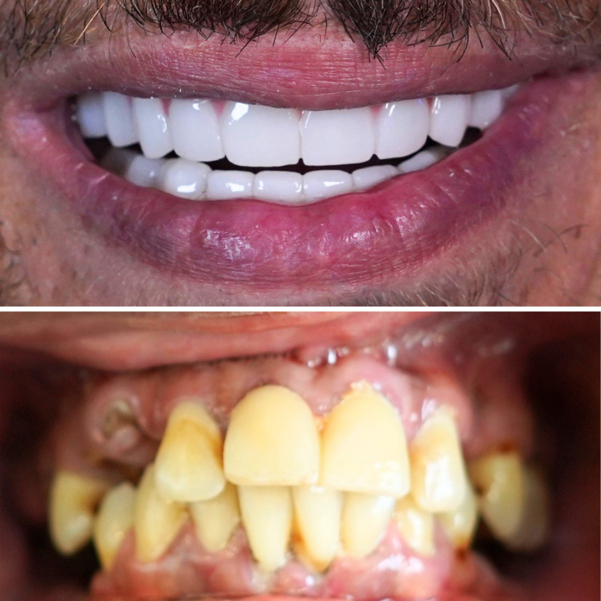 نتائج قبل وبعد تجميل الابتسامة – قشور الأسنان لتحول الأسنان إلى بيضاء ومتساوية