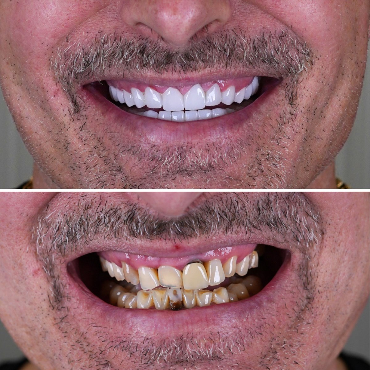 Smile makeover before and after results – whiter, even teeth after dental veneers procedure