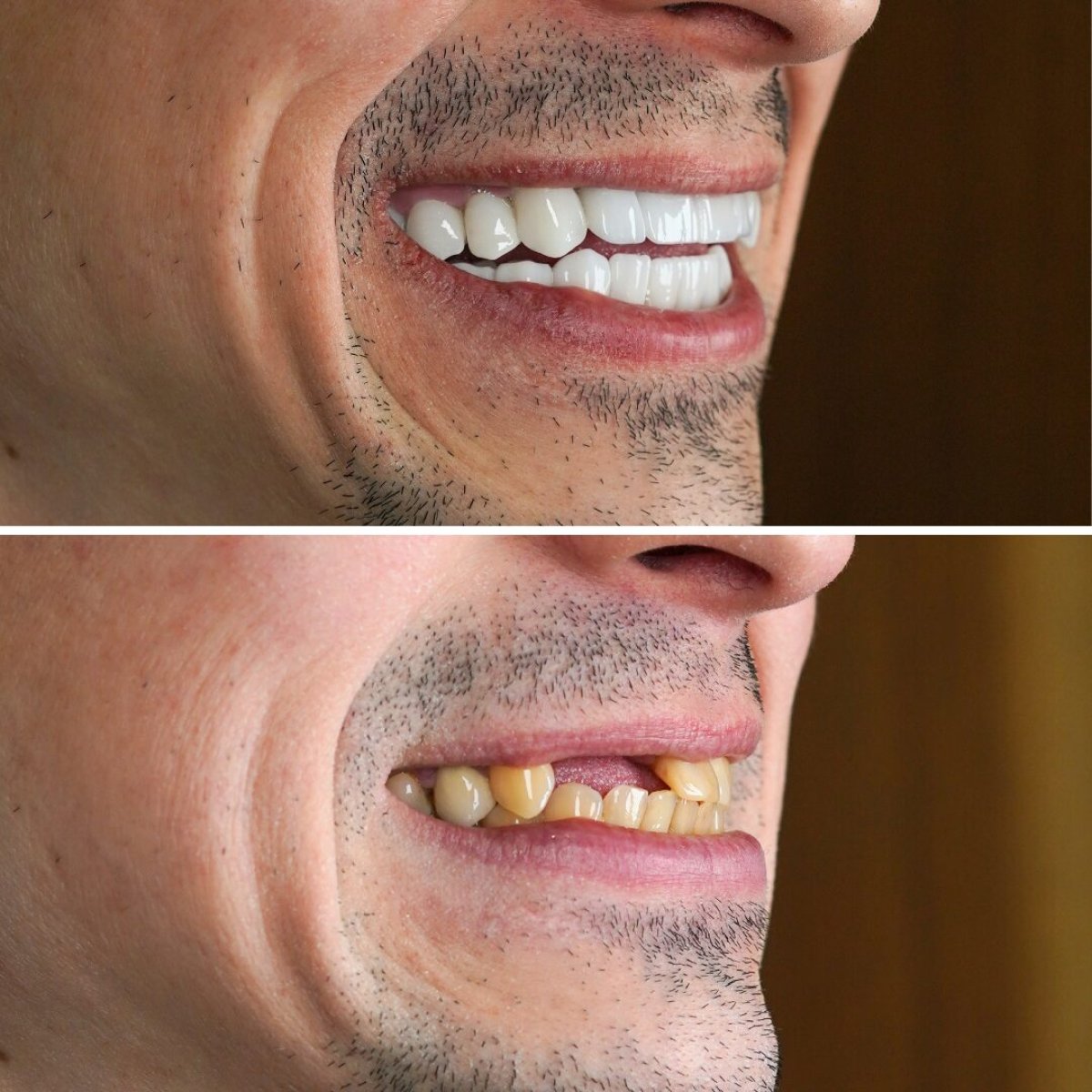 Результаты до и после Hollywood Smile – виниры для белых и ровных зубов
