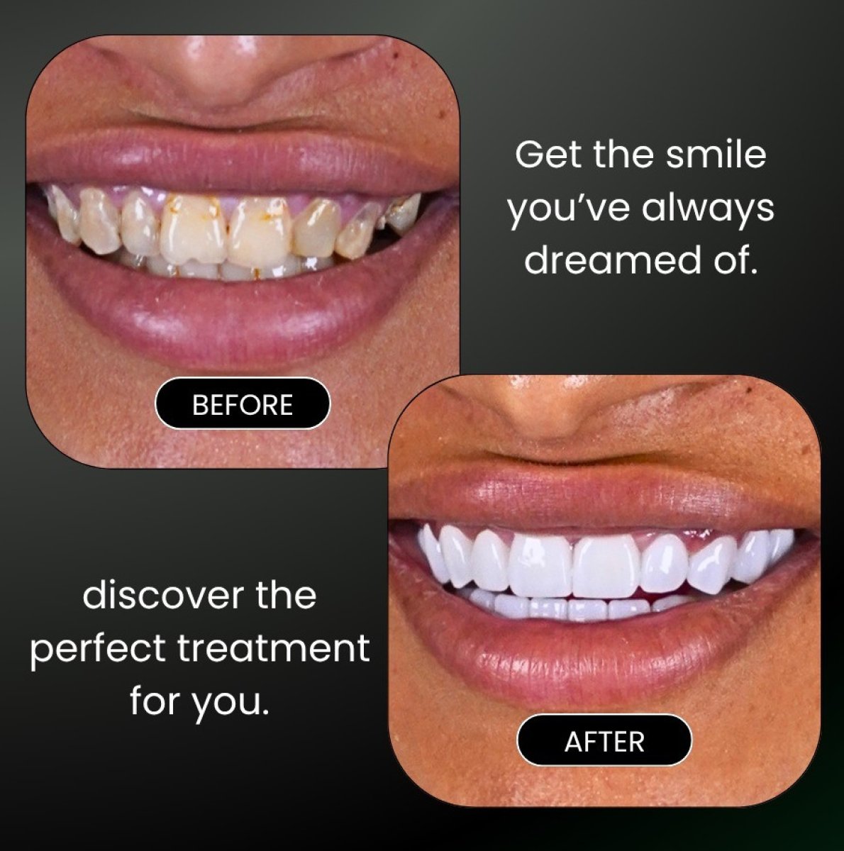 Resultados de blanqueamiento dental antes y después: sonrisa visiblemente más brillante