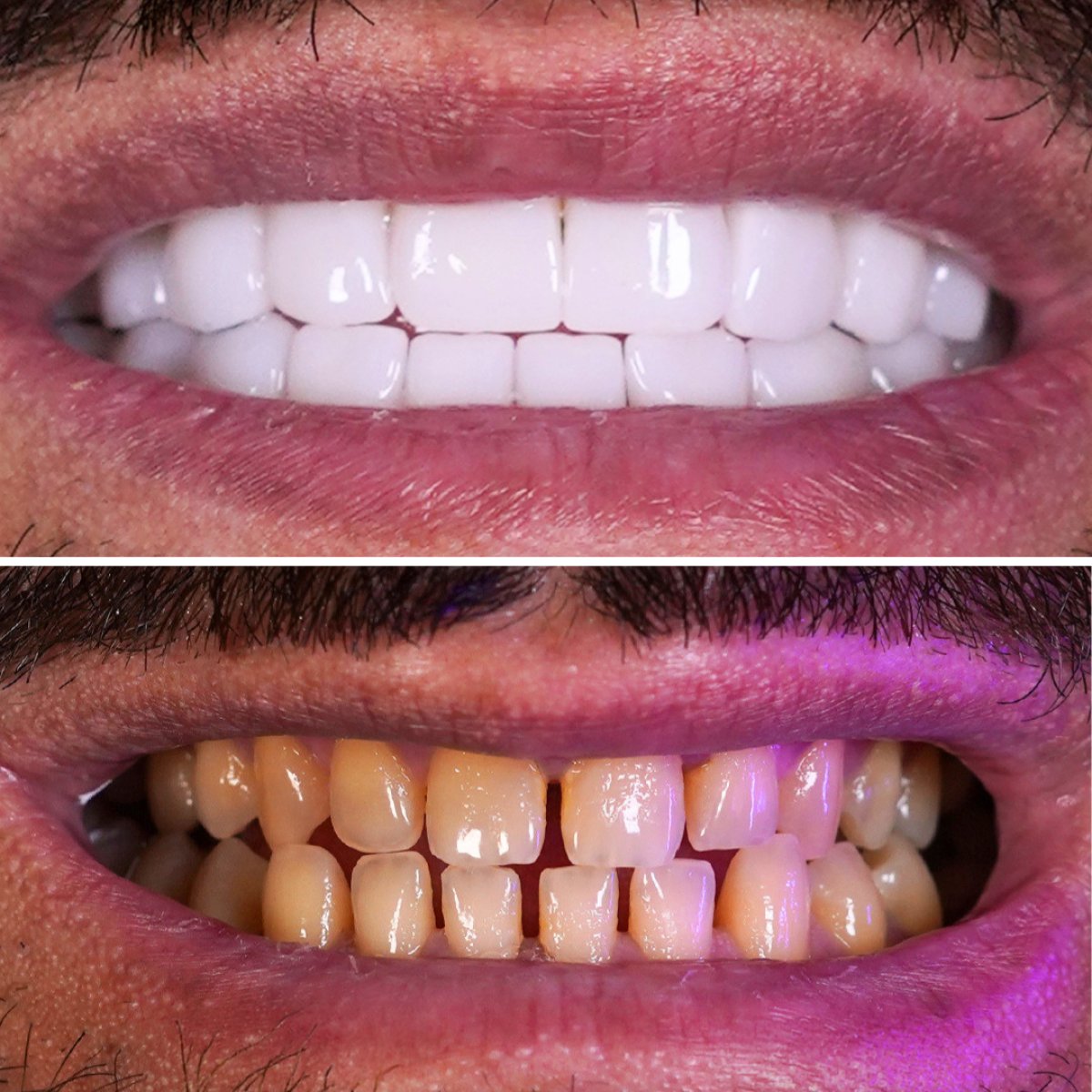 Résultat avant/après facettes dentaires – sourire plus blanc et aligné
