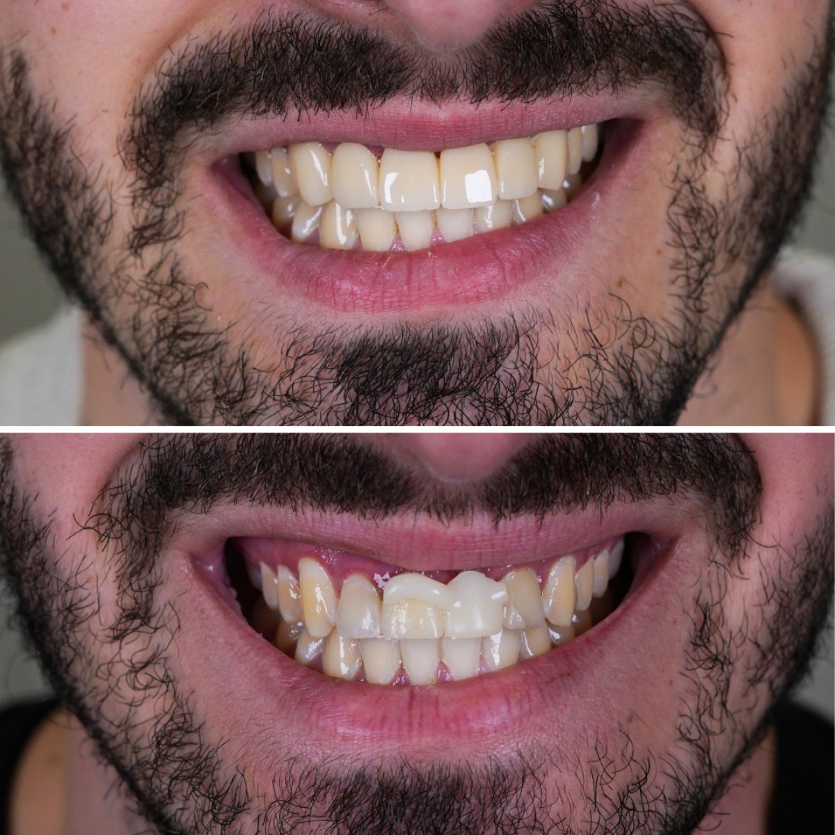 Résultat avant et après facettes dentaires – sourire amélioré et dents plus blanches