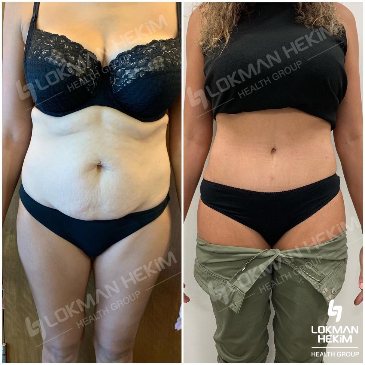 Résultats avant/après de la liposuccion abdominale à Lokman Hekim Istanbul Hospital, taille affinée