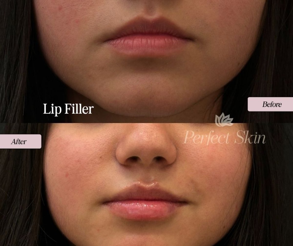 Résultats avant et après injection de filler lèvres chez PERFECT SKIN CANCÚN, volume accru