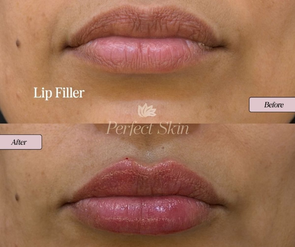 Résultats avant/après injection de filler lèvres chez PERFECT SKIN CANCÚN, volume accru