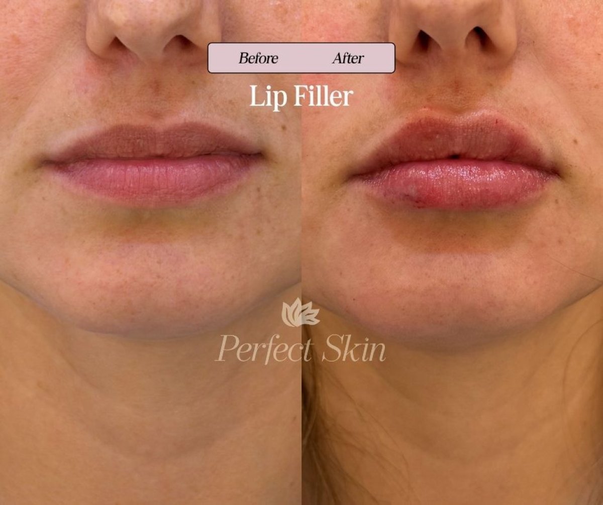 Before and after lip fillers at PERFECT SKIN CANCÚN, enhanced lip volume and contour result