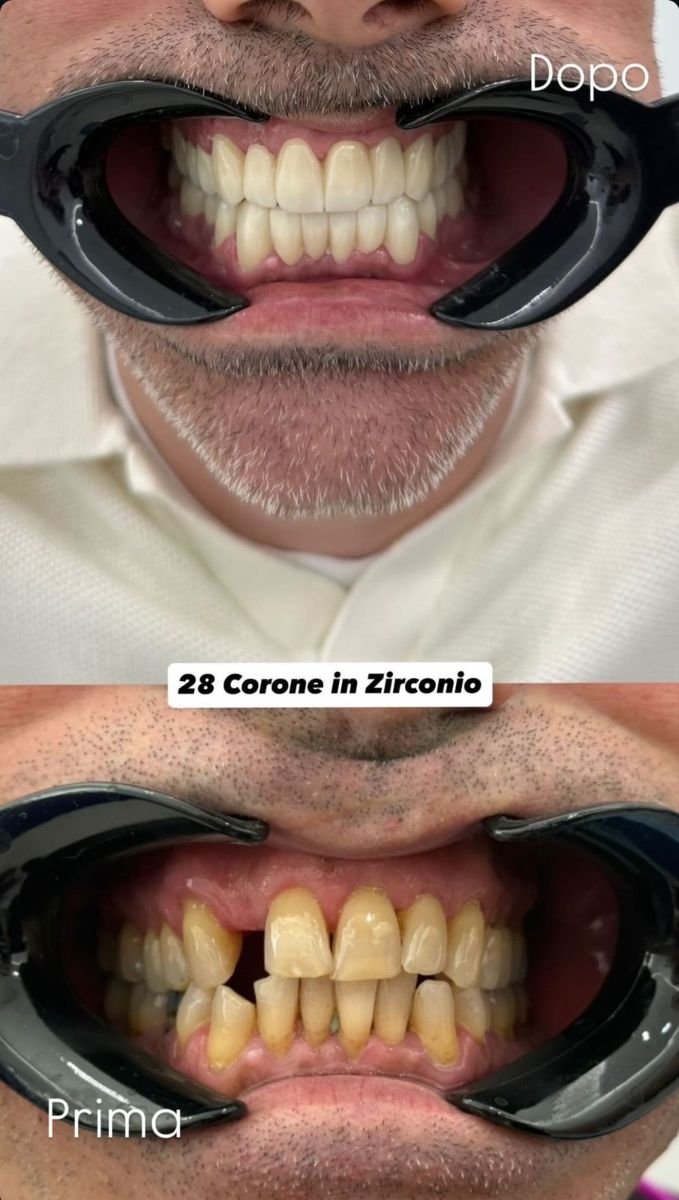 Résultat avant et après couronnes en zircon chez Santa Caterina Clinic Dental & Aesthetic Medicine