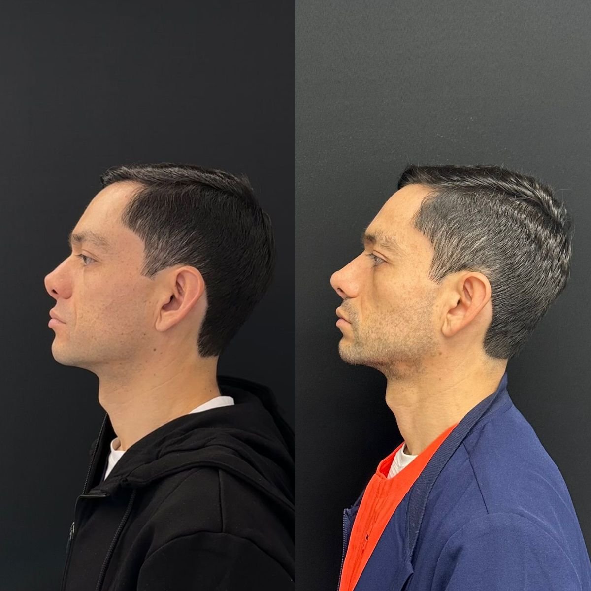 Resultado antes y después de rinoplastia secundaria en Zafir Medical Center, perfil nasal mejorado