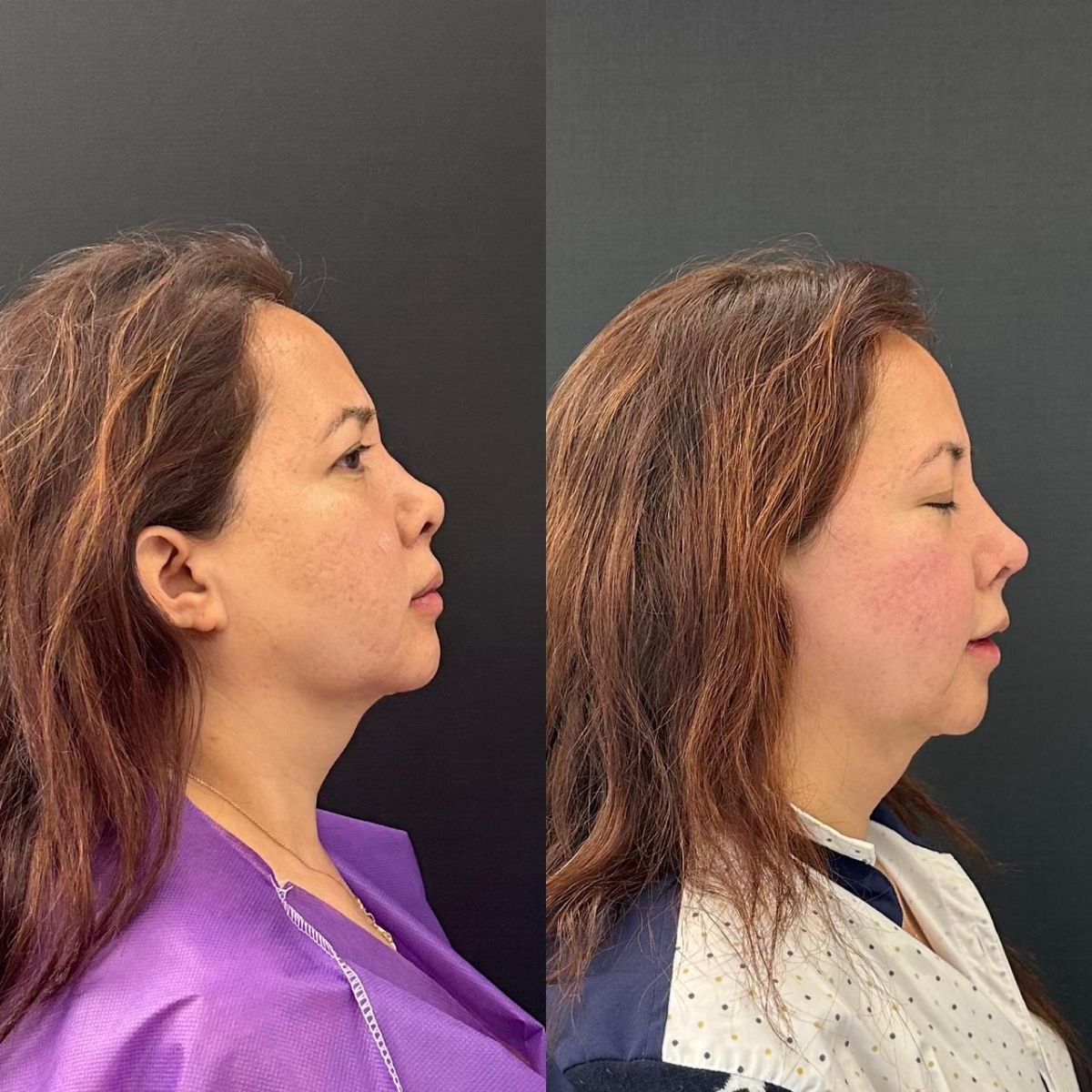 نتيجة قبل وبعد عملية تجميل الأنف التصحيحية في مركز زافير الطبي، تحسين شكل الأنف