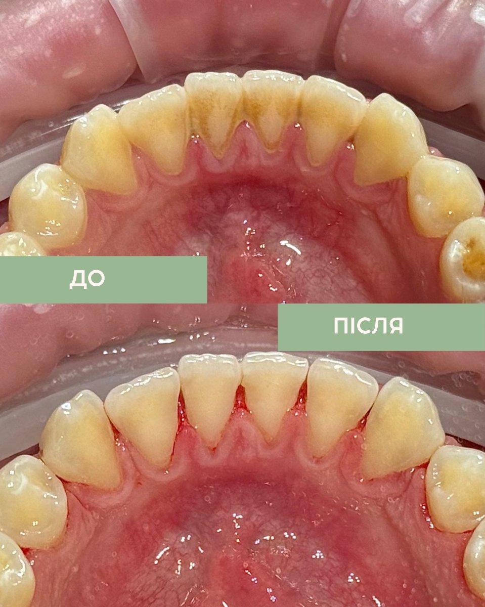 Before and after teeth cleaning (scaling) results – visible plaque removal and cleaner teeth