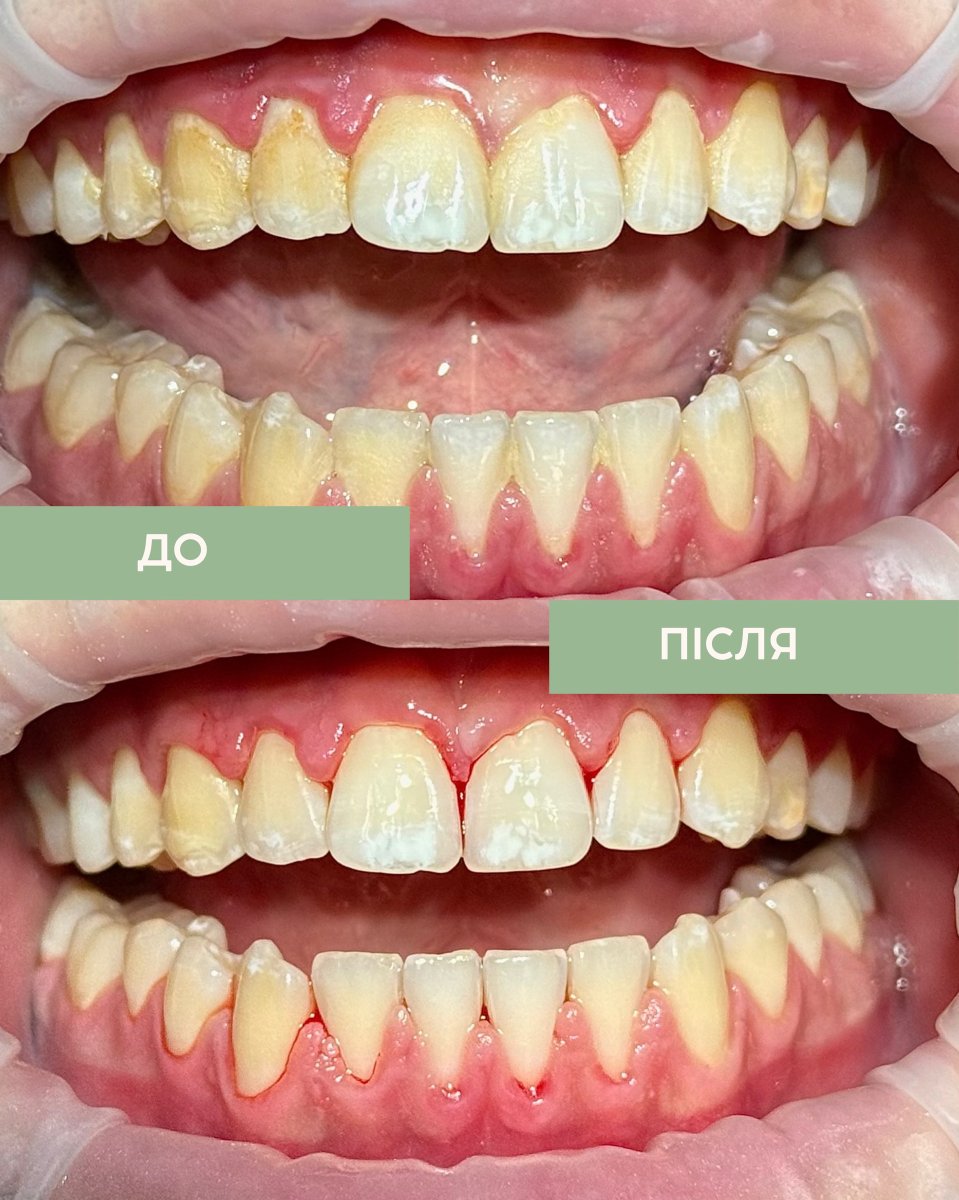 Before and after teeth cleaning (scaling) results – improved dental hygiene and whiter teeth