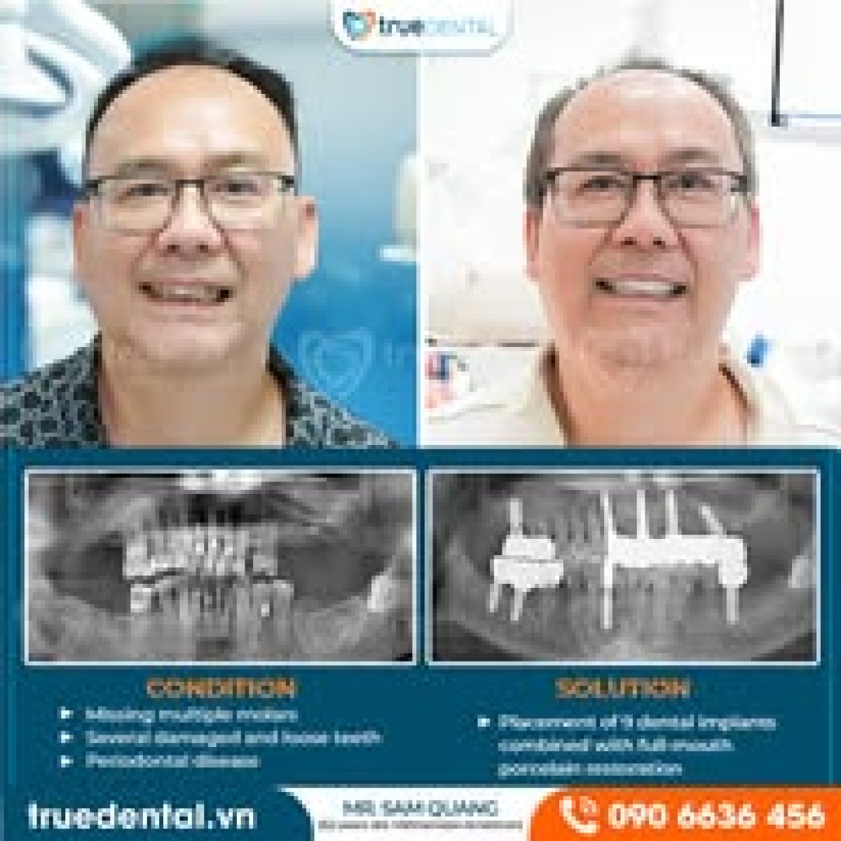 نتائج زراعة الأسنان قبل وبعد في عيادة True Dental – استعادة الابتسامة ووظيفة الأسنان