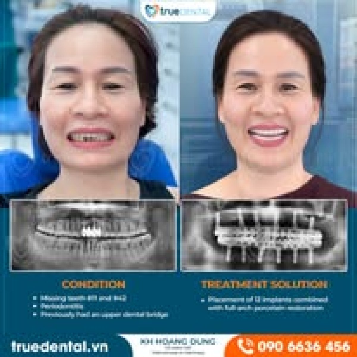 Efekty przed i po implantacji zębów w True Dental Clinic – pełna odbudowa uśmiechu