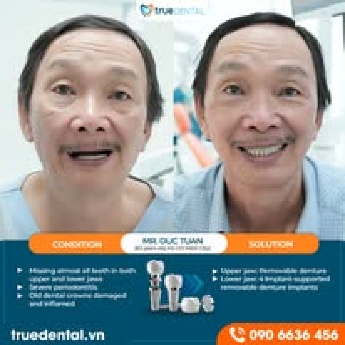 نتائج زراعة الأسنان قبل وبعد في True Dental – ابتسامة مستعادة وتعويض الأسنان المفقودة