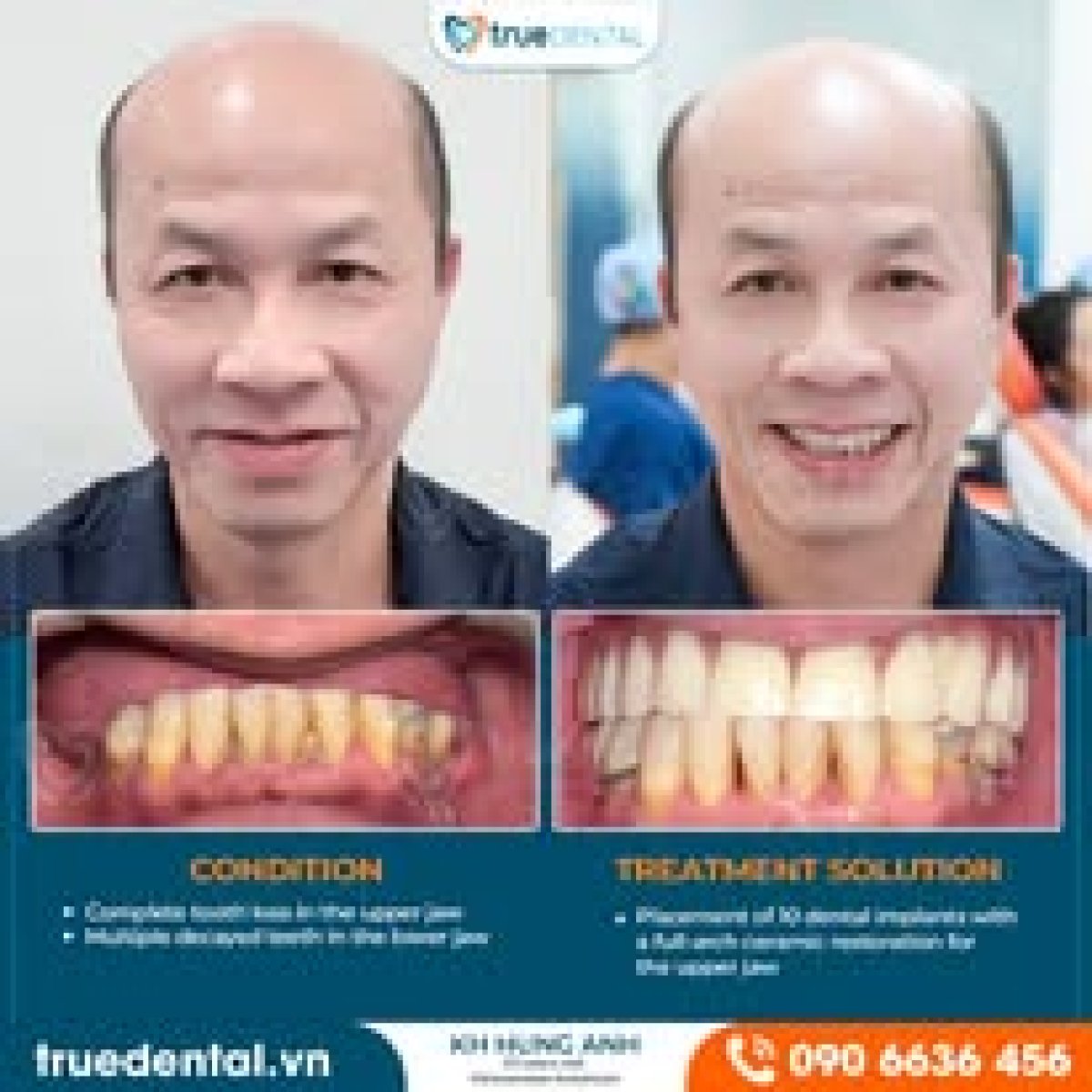 نتائج زراعة الأسنان قبل وبعد في True Dental – ابتسامة مستعادة وتحسن الأسنان