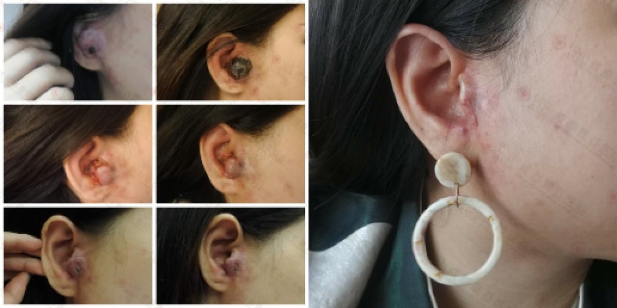AVM embolization before and after results at Uni-asia Cancer hospital, ear healing progress
