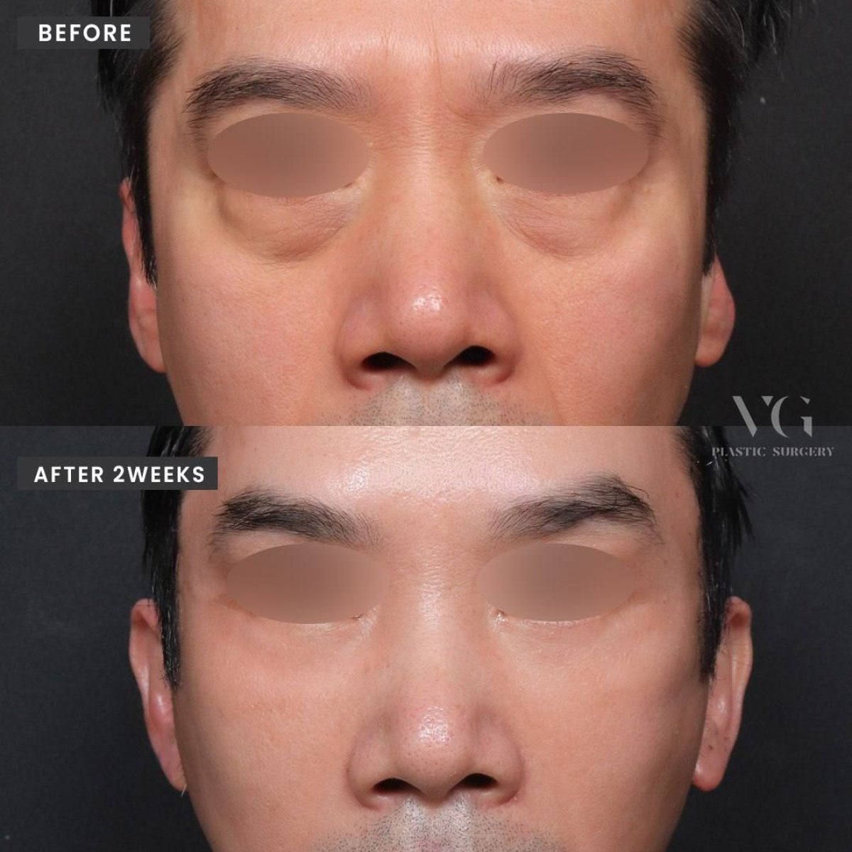نتائج رأب الجفن قبل وبعد في VG Plastic Surgery، تصحيح الجفون خلال أسبوعين