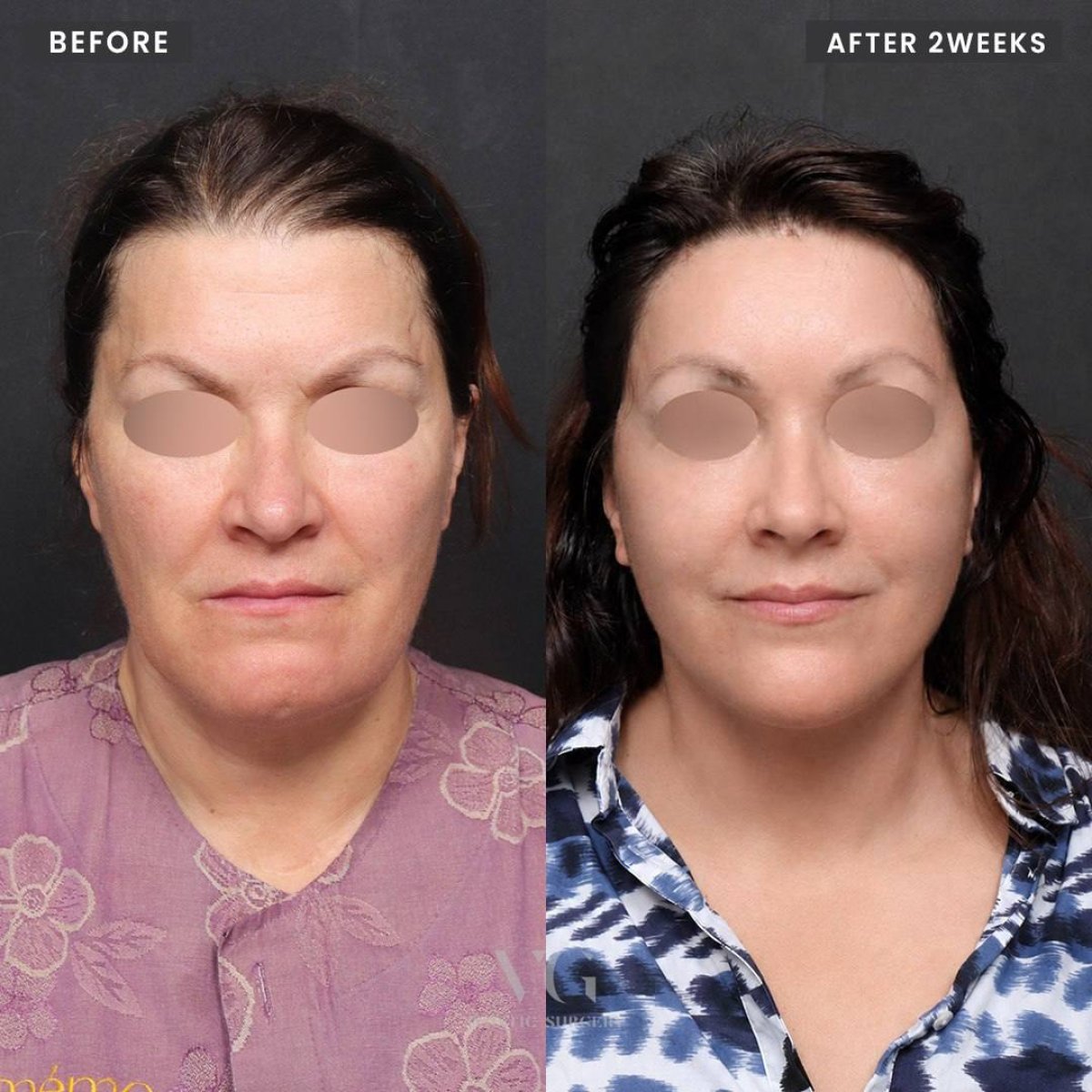Resultados de minilifting facial antes y después en VG Plastic Surgery, rejuvenecimiento visible