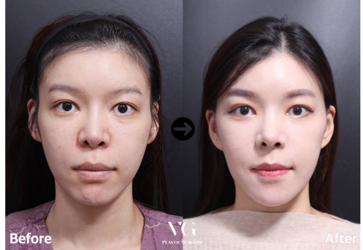 Resultados de minilifting facial antes y después en VG Plastic Surgery – rejuvenecimiento visible