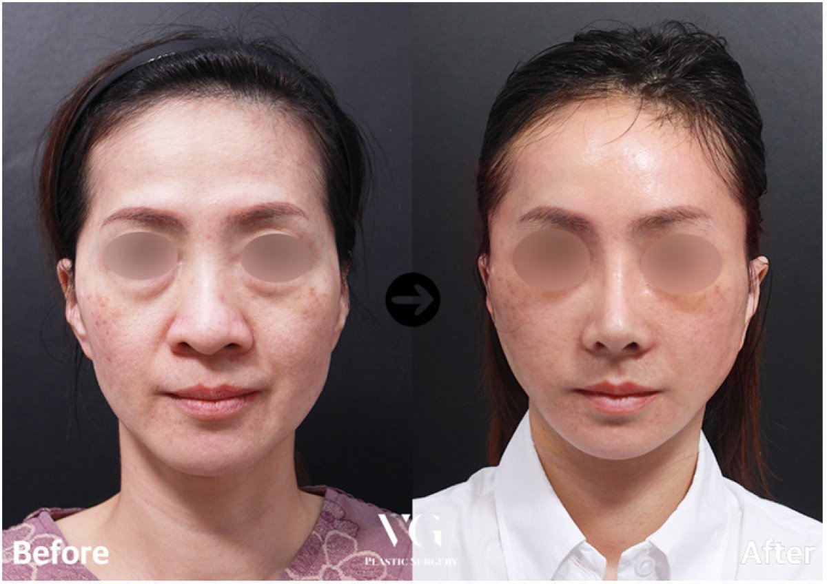 نتائج شد الوجه المصغر قبل وبعد في VG Plastic Surgery – تجديد شباب الوجه