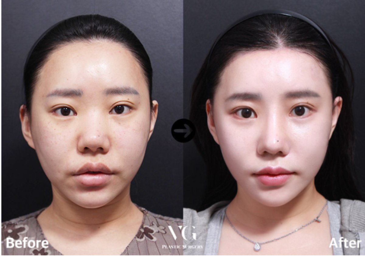 نتائج شد الوجه المصغر قبل وبعد في VG Plastic Surgery، تجديد واضح للبشرة