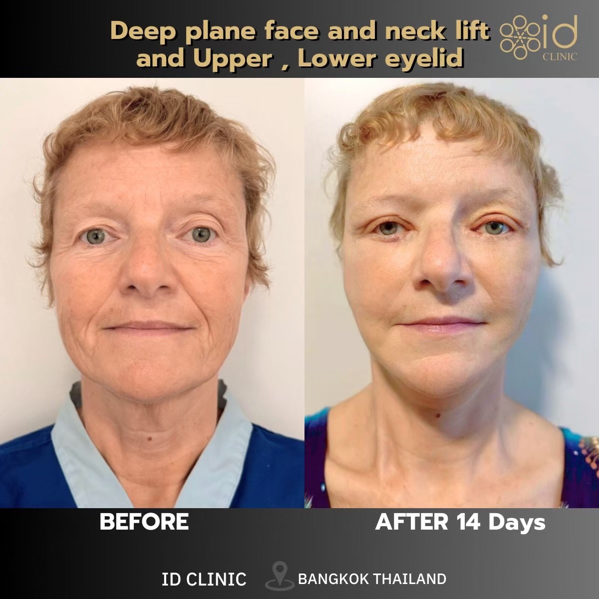 Before and after deep plane facelift, neck lift, and eyelid surgery results at ID Clinic Bangkok