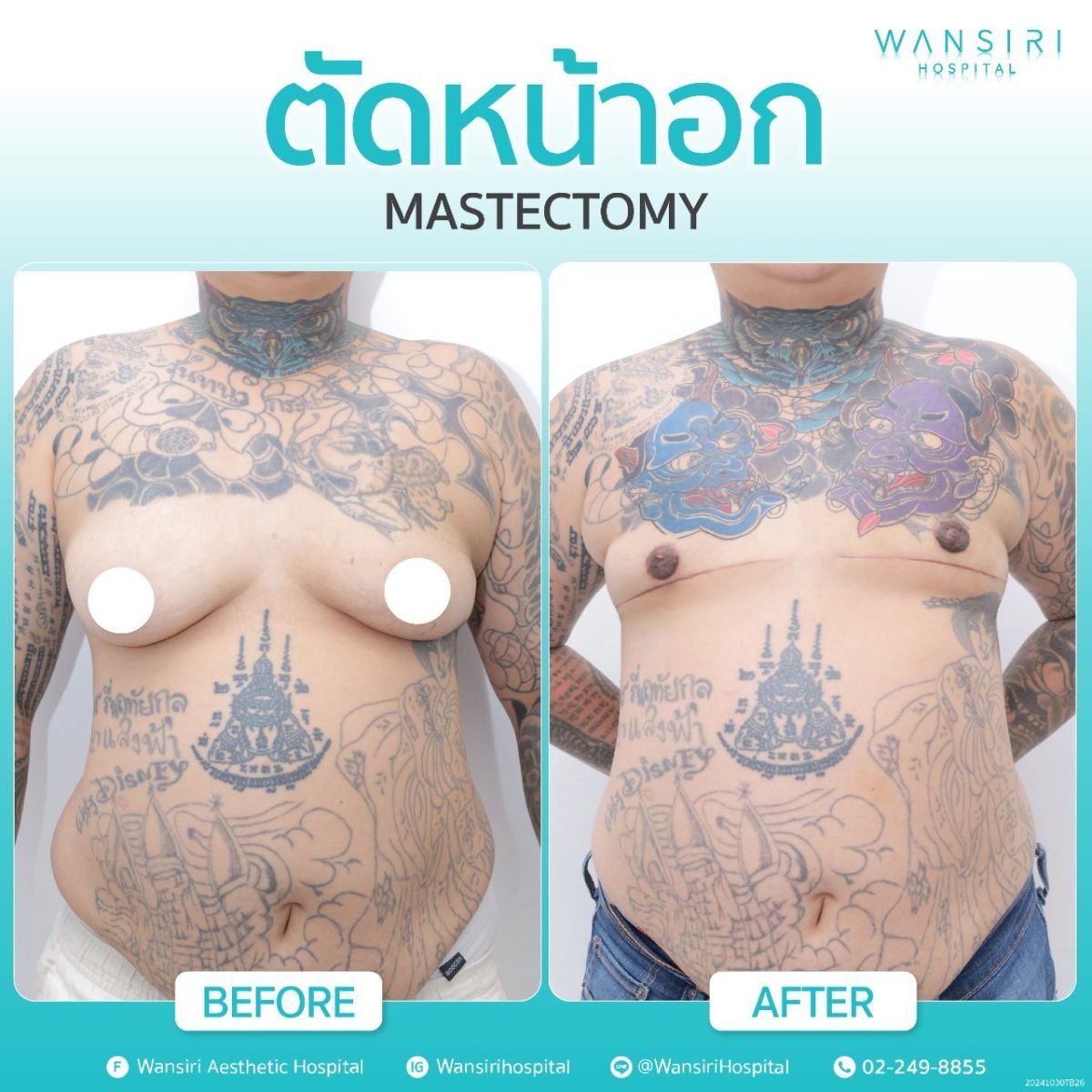 Before and after gynecomastia surgery results at Wansiri Hospital – flatter chest contour