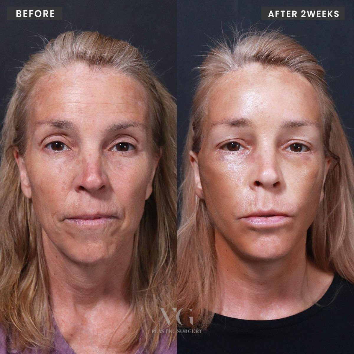 Resultados de blefaroplastia antes y después en VG Plastic Surgery, corrección visible de párpados