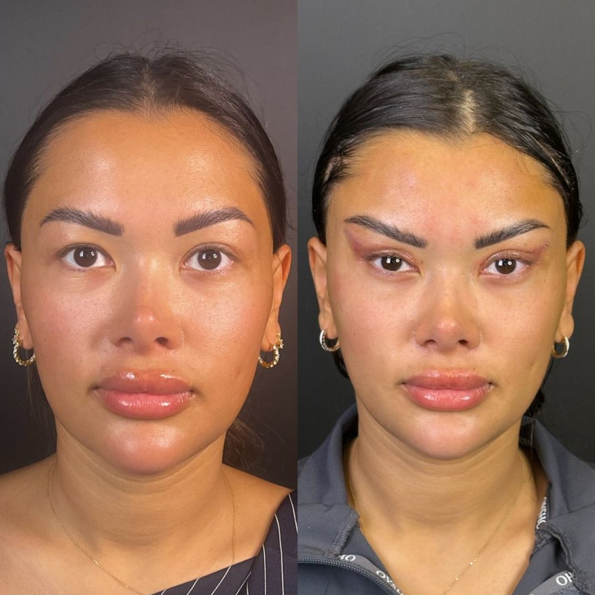 نتائج عملية تجميل الأنف قبل وبعد في عيادة البروفيسور د. فوركان كارابيكميز أنقرة