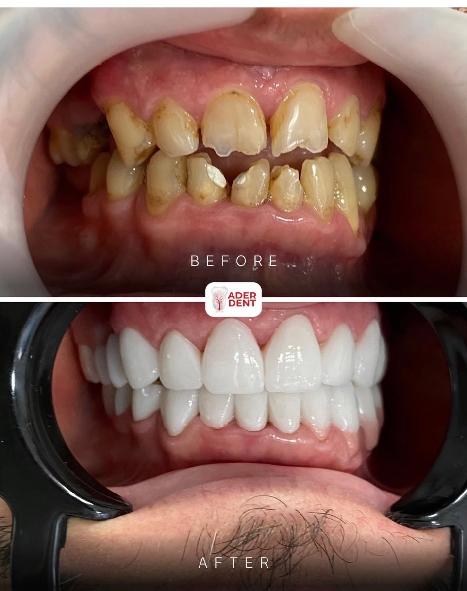 Результаты до и после улыбки в Ader Dent Oral and Dental Health Polyclinic