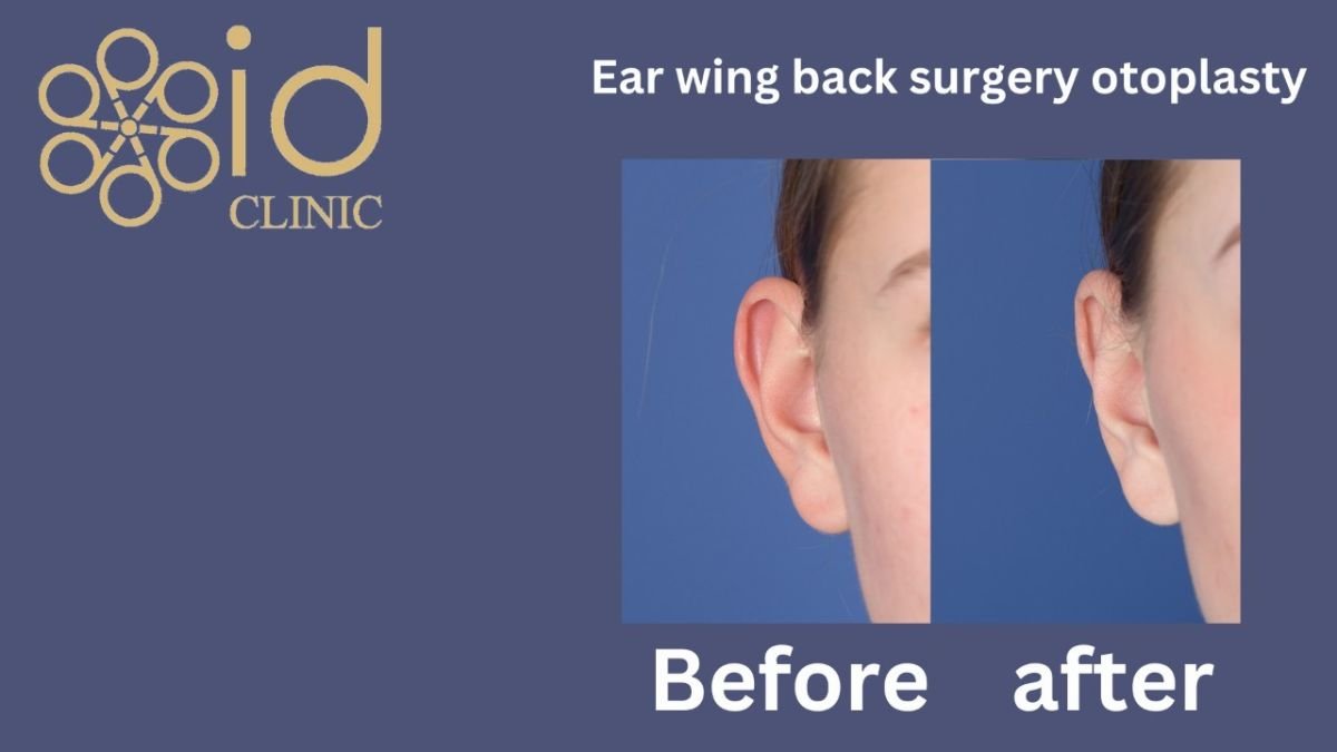 Before and after otoplasty results at ID Clinic Bangkok, ear reshaping surgery improvement