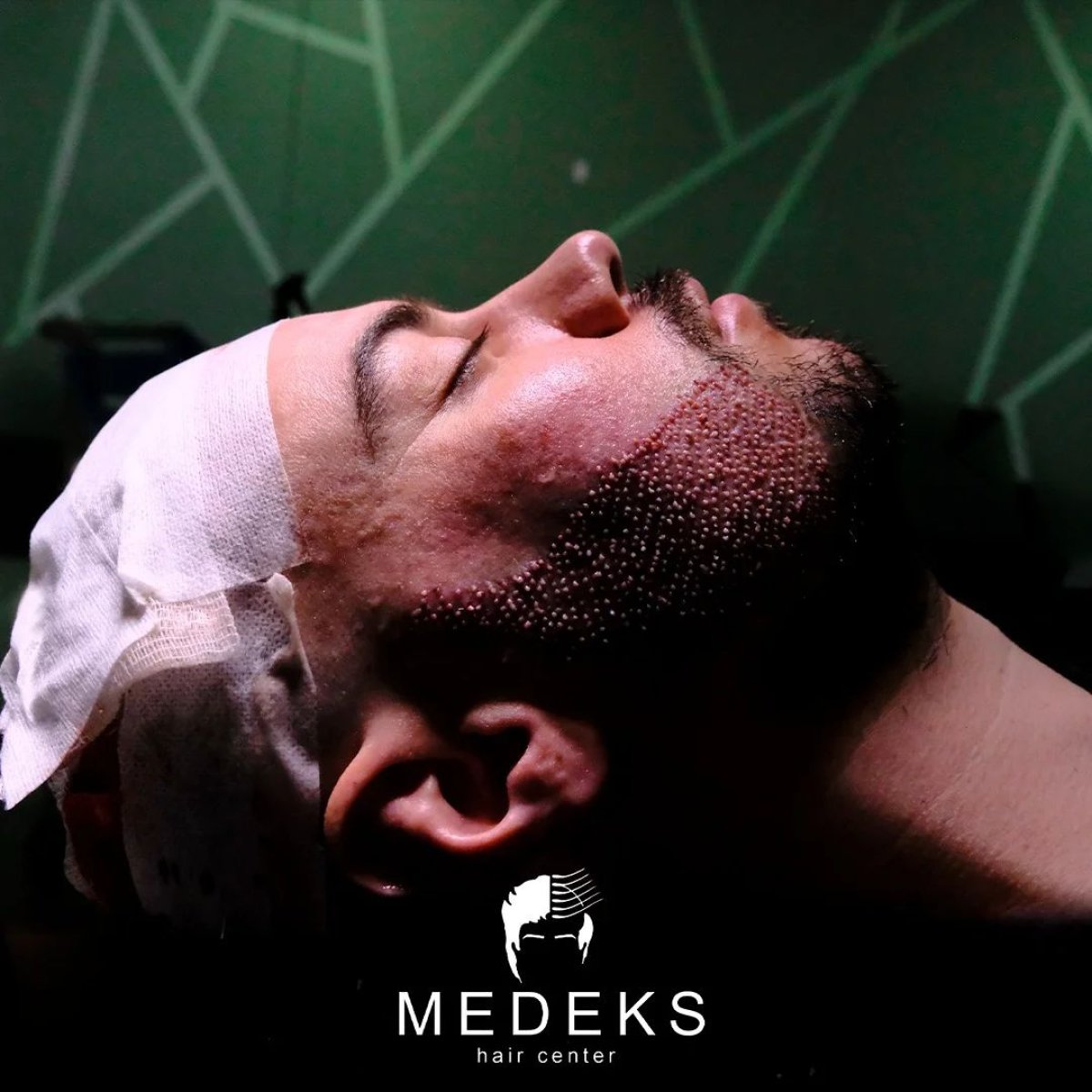 Resultado de trasplante de barba en Medeks Hair Center, injertos visibles en la mejilla